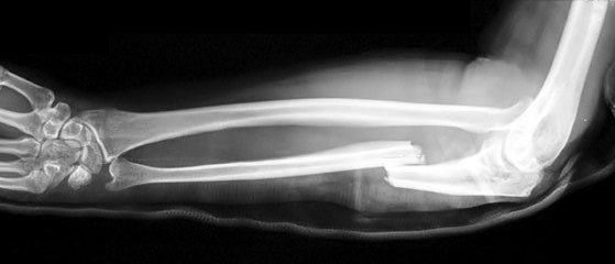 An x-ray showing a broken human forearm.